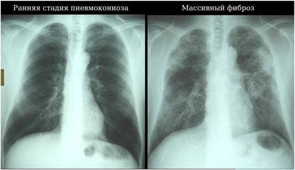 Ранняя стадия пневмокониоза и массивный фиброз лёгких 