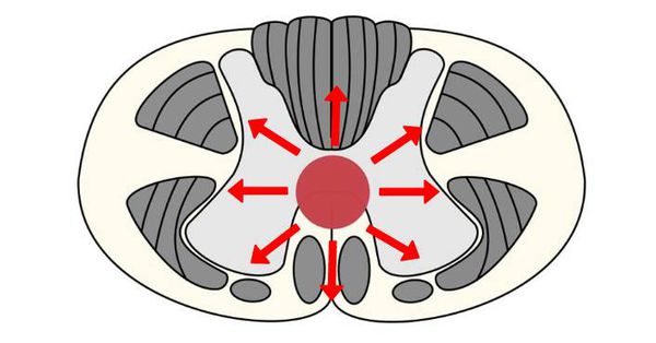Расширение полости в спинном мозге