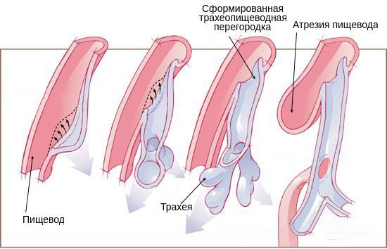 Разделение пищевода и трахеи у эмбриона и формирование атрезии пищевода