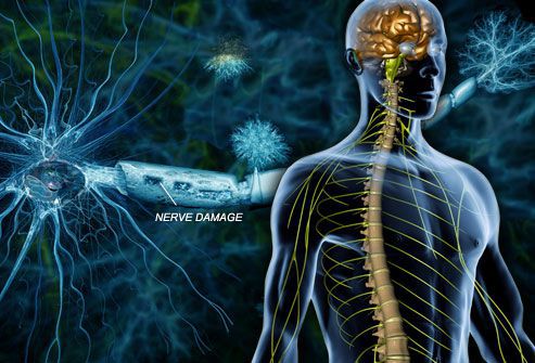 Разрушение миелиновой оболочки нервных волокон при рассеянном склерозе