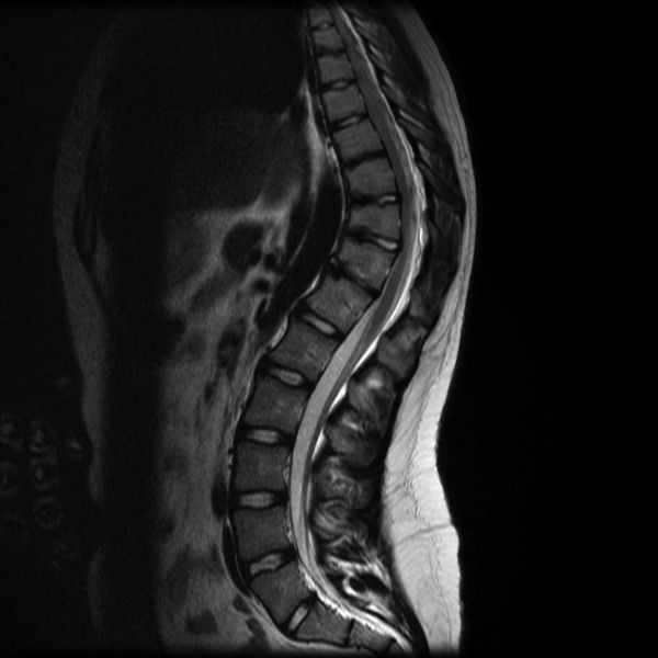 Ренгенографический снимок при болезни Шейермана — Мау 