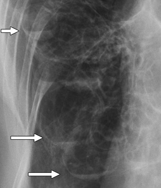 Рентгенография множественных кист с воздухом и жидкостью 