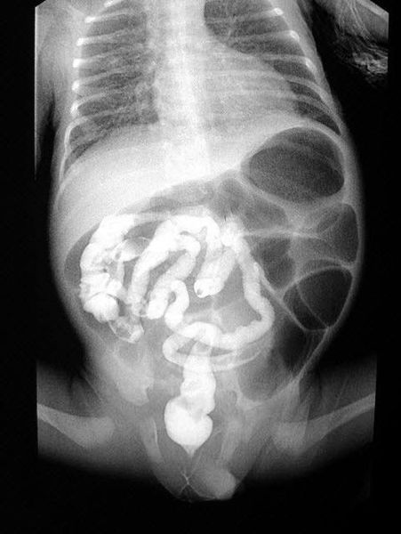 Рентгенограмма брюшной полости при муковисцидозе