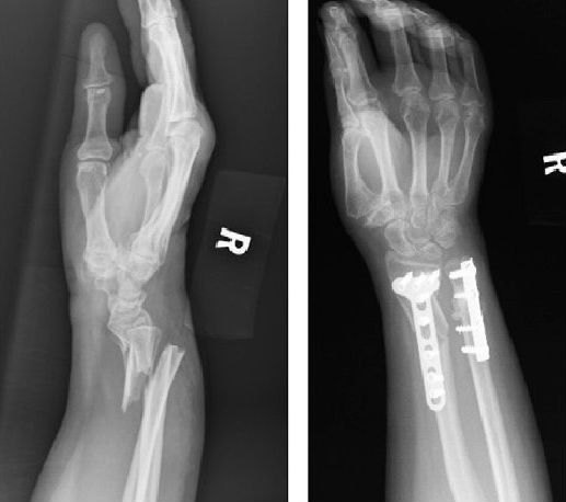 Рентгеновские снимки до и после оперативного лечения закрытого перелома