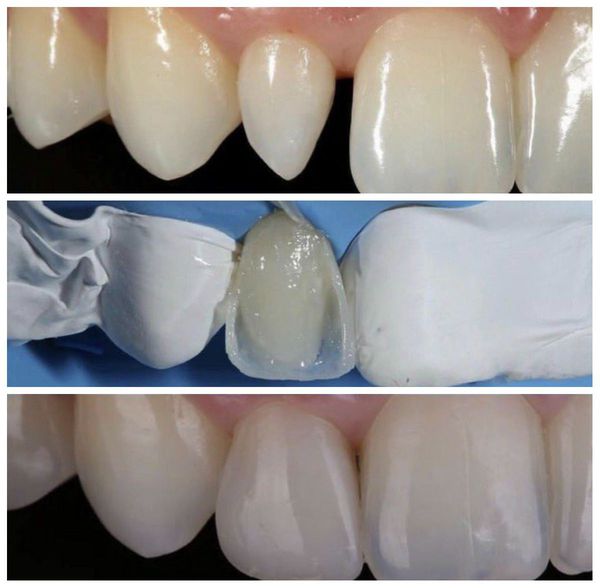 Реставрация "конического" зуба
