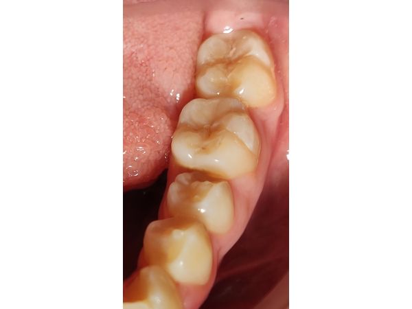 Нижние зубы до лечения