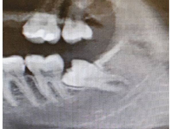 Прицельный рентгенологический снимок зуба 38