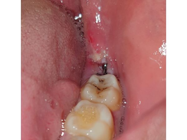 Заживление лунки удалённого зуба 38