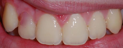 Розовое пятно на зубе 