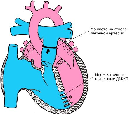 Сердце с множественными мышечными ДМЖП после суживания лёгочной артерии