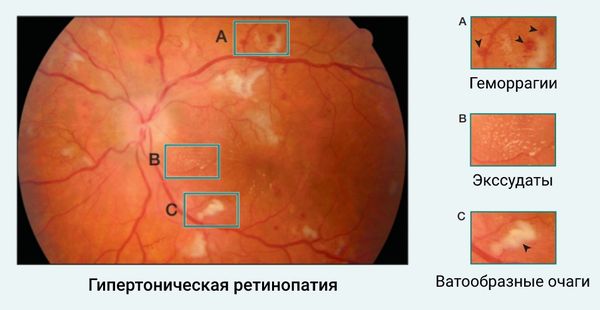 Сетчатка при гипертонической ретинопатии 