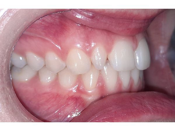 Зубы до лечения (в профиль)