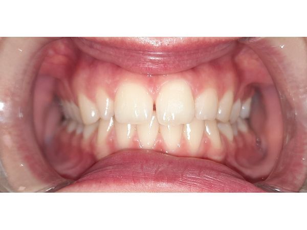 Зубы до лечения (анфас)