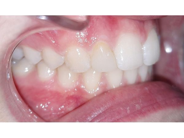 Зубы после лечения (в профиль)
