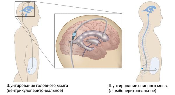 Шунтирование головного и спинного мозга