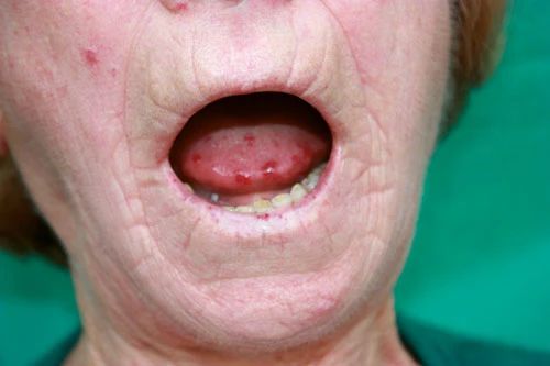 Симптом «кисета» и уменьшение диаметра отверстия рта 