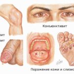 https://dgp1nn.ru/blog/wp-content/uploads/simptomy-bolezni-ryaytera-s-1ho4bwk.jpg