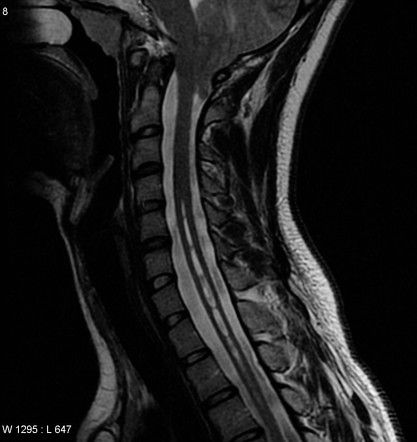 Сирингомиелитичекие полости (белые стрелки) в шейном отделе спинного мозга при МРТ 