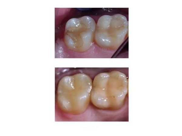 Зуб 27 до и после лечения