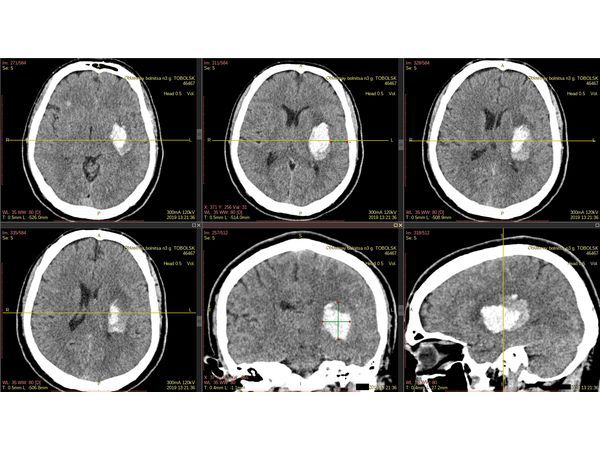 КТ головного мозга при поступлении пациента