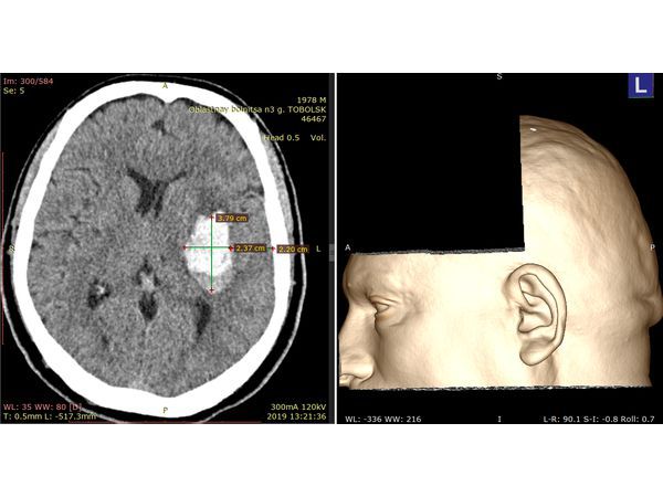 При помощи инструмента "Нож" в 3D-модели головы пациента сформирован доступ к внутримозговой гематоме