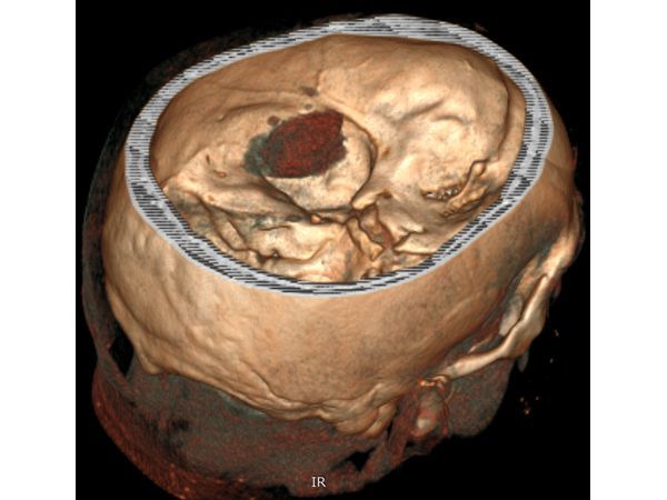Модификация 3D-модели головы пациента: вид внутримозговой гематомы изнутри полости черепа