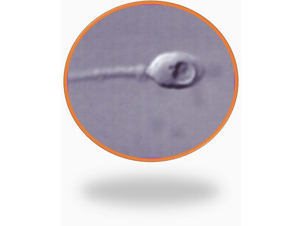 Отбор сперматозоидов для ЭКО ИМСИ. Увеличение 6 000 крат.