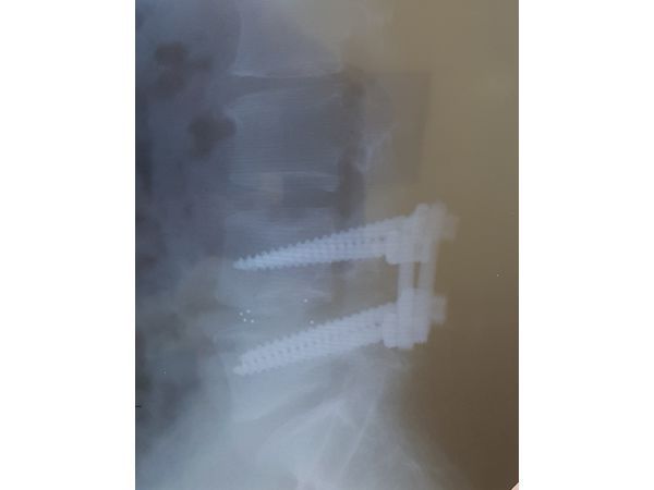 Рентгенография ПКОП после операции