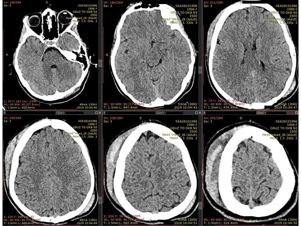 КТ головного мозга при поступлении. Видна гематома мягких тканей справа.