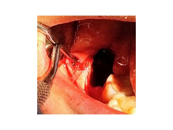 Вид операционного поля после удаления ретенированного зуба