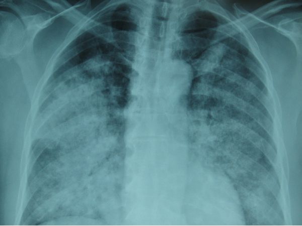 Рентгенограмма от 12.10. Картина интерстициальной пневмонии. Двусторонняя инфильтрация с изменениями по типу "матового стекла" и расширением корней.