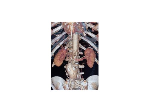 КТ-ангиографический снимок аневризмы брюшного отдела аорты