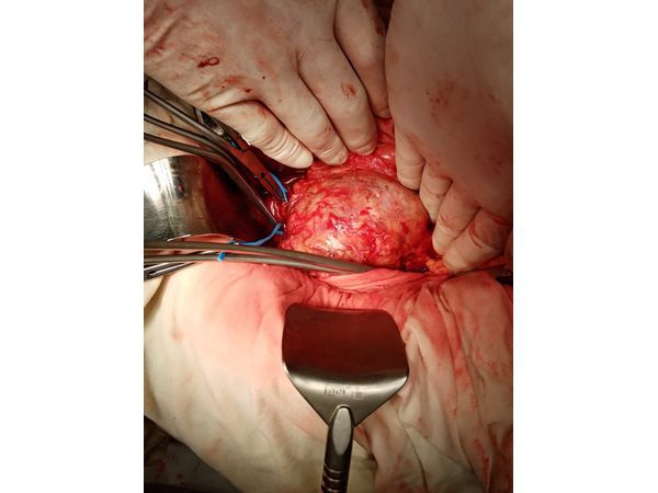 Аневризма брюшного отдела аорты в операционном доступе