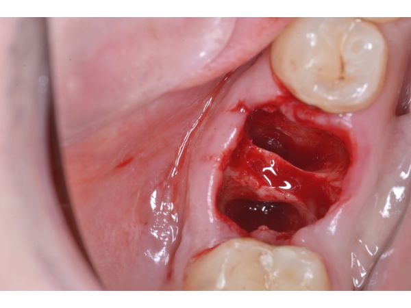 Лунка зуба 4.6 после удаления и антисептической обработки 