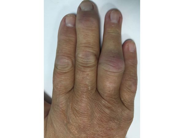 Тофус в области межфалангового сустава четвёртого пальца правой кисти