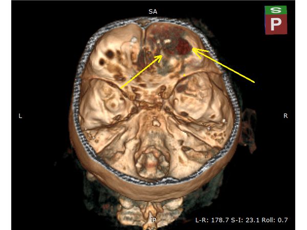 3D-разметка проекции внутримозговой гематомы на свод черепа: вид сзади и сверху