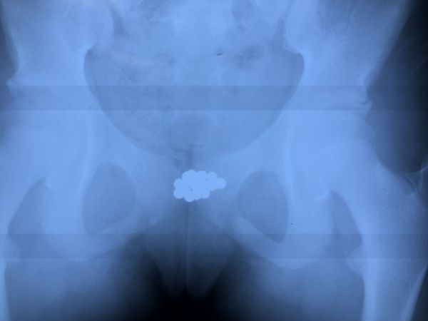 Рентгенография, инородные тела мочевого пузыря