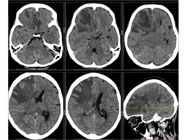 КТ головного мозга без контраста, проведённое при поступлении пациентки
