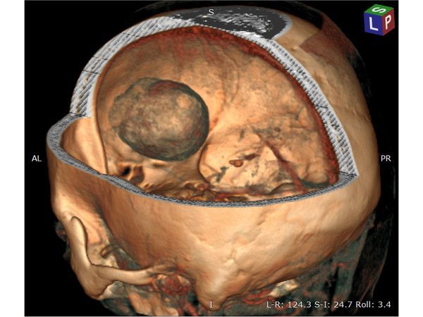 3D-реконструкция объёмного образования правой лобной доли головного мозга, выполненная на основании сканов КТ с контрастным усилением