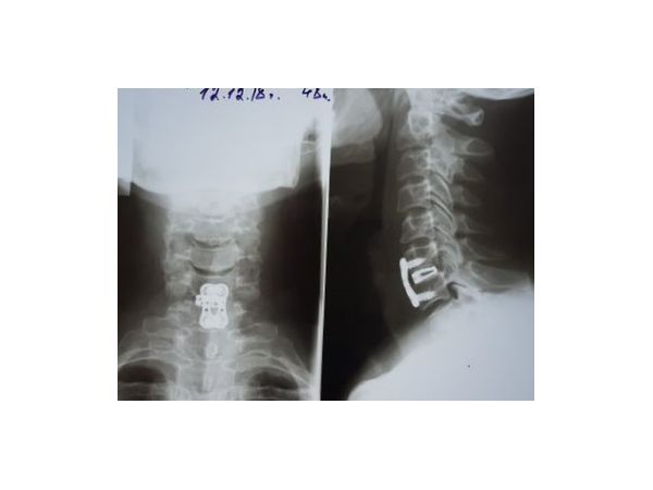 Контрольная рентгенография на второй день после операции
