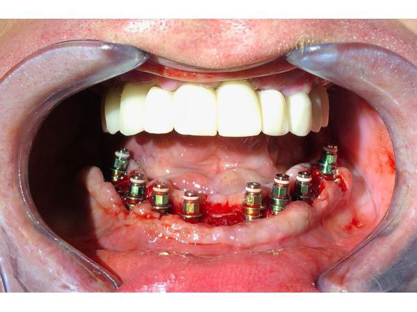 Установка имплантатов на нижнюю челюсть (через 11 дней после удаления зубов)