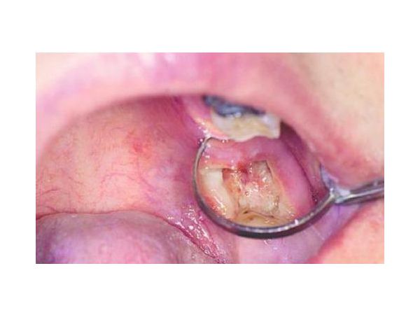 Фото в полости рта: альвеолит после удаления зуба