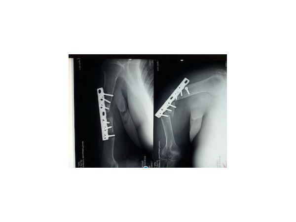 Снимок при первичном поступлении: ложный сустав плечевой кости, нестабильность отломков