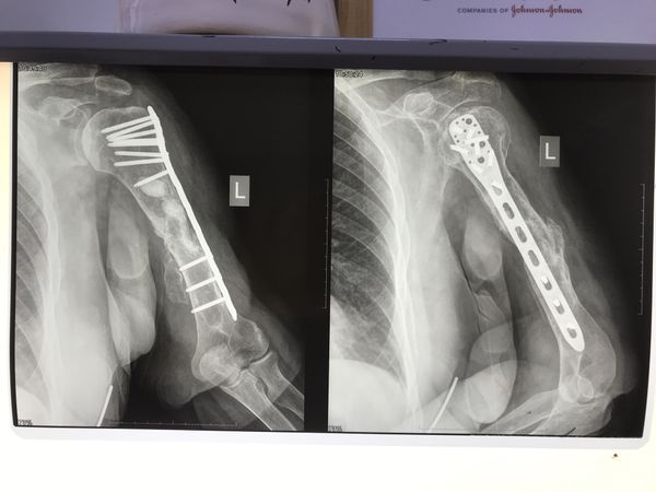 Снимок через 3 года после травмы: полное сращение плечевой кости и перестройка трансплантата из гребня подвздошной кости