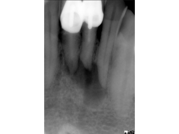 Рентгенограмма 31 и 41 зубов до лечения