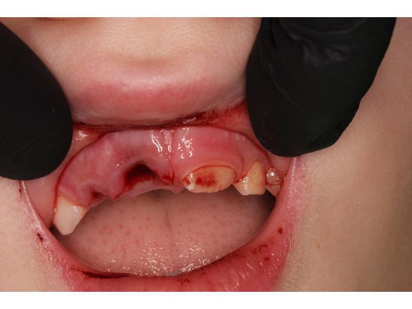 Авульсия, или полный вывих зуба