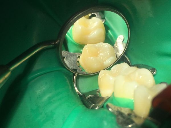 26 и 27 зубы после реставрации