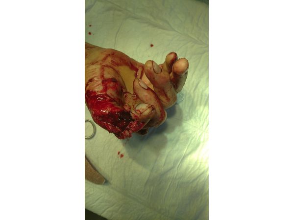 Травматическая ампутация большого пальца правой кисти