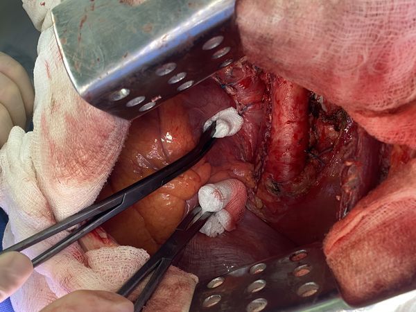 Интраоперационно фото: операционная рана перед ушиванием
