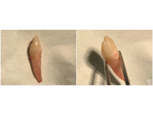 Фото зуба с разных сторон 
